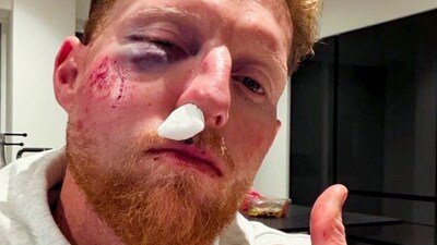 Ben Stokes suffered injuries after being struck on the face by a cricket ball during a training session. (Ben Stokes Insta)