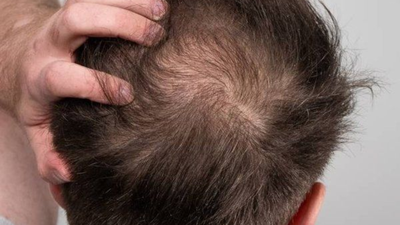'Hair loss impacted my self-esteem':  LeT terrorist says he went for transplant in India