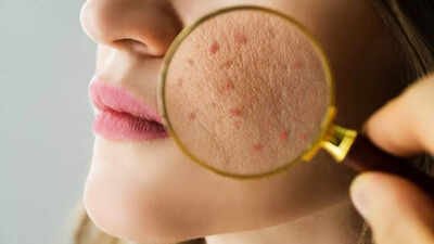 Freckles, Sunspots and Acne Marks? Dermatologists Share the Best Skincare Solutions Can’t get rid of dark spots, pigmentation, uneven skin tone this summer? Dermatologists reveal treatments that deliver visible results against sun damage