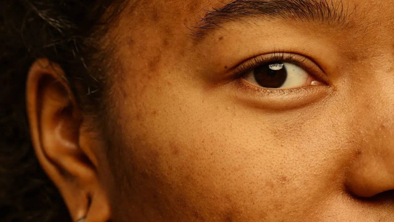 Goodbye Patchy Skin: The New-Age Laser Treatments Making Dull Skin Radiant Again