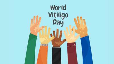 Vitiligo is not contagious: Dermatologist urges people to look beyond the skin this World Vitiligo Day