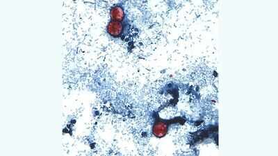 Diarrhoea-causing parasitic infection (AP image) Nearly 1,000 cyclospora cases reported in Michigan in largest-ever parasite outbreak