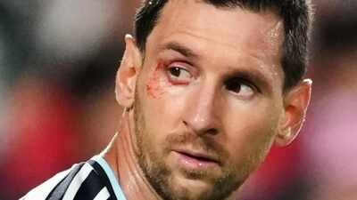 Argentina's Lionel Messi, with a mark by his eye, looks back during the World Cup quarterfinal football match between Argentina and Switzerland in Kansas City, Mo., Saturday, July 11, 2026. (AP Photo) No easy wins in FIFA World Cup: Lionel Scaloni says 'suffering part of our DNA' as Argentina survive Switzerland scare
