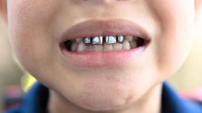 File Photo: Canva Who are ‘silver tooth kids’ and why is the internet calling them ‘bad’?