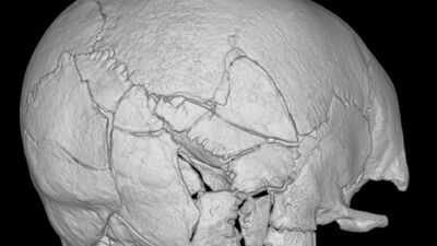 The 14th century warrior’s skull was broken in 61 places. (University of Bradford photo) A skeleton found beneath Scotland's Stirling Castle had more than 160 fractures; researchers say it is the first confirmed death from a trebuchet