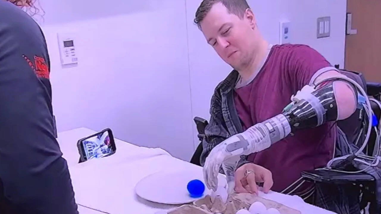 Florida man gets bionic arm that lets him feel again