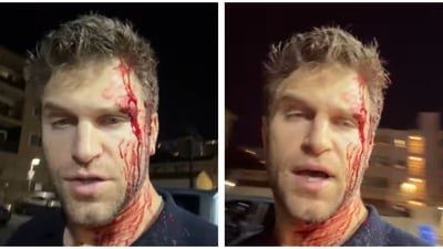 Keegan Allen shared a video of his bloodied face after the incident on Instagram. Keegan Allen shared a video of his bloodied face after the incident on Instagram.